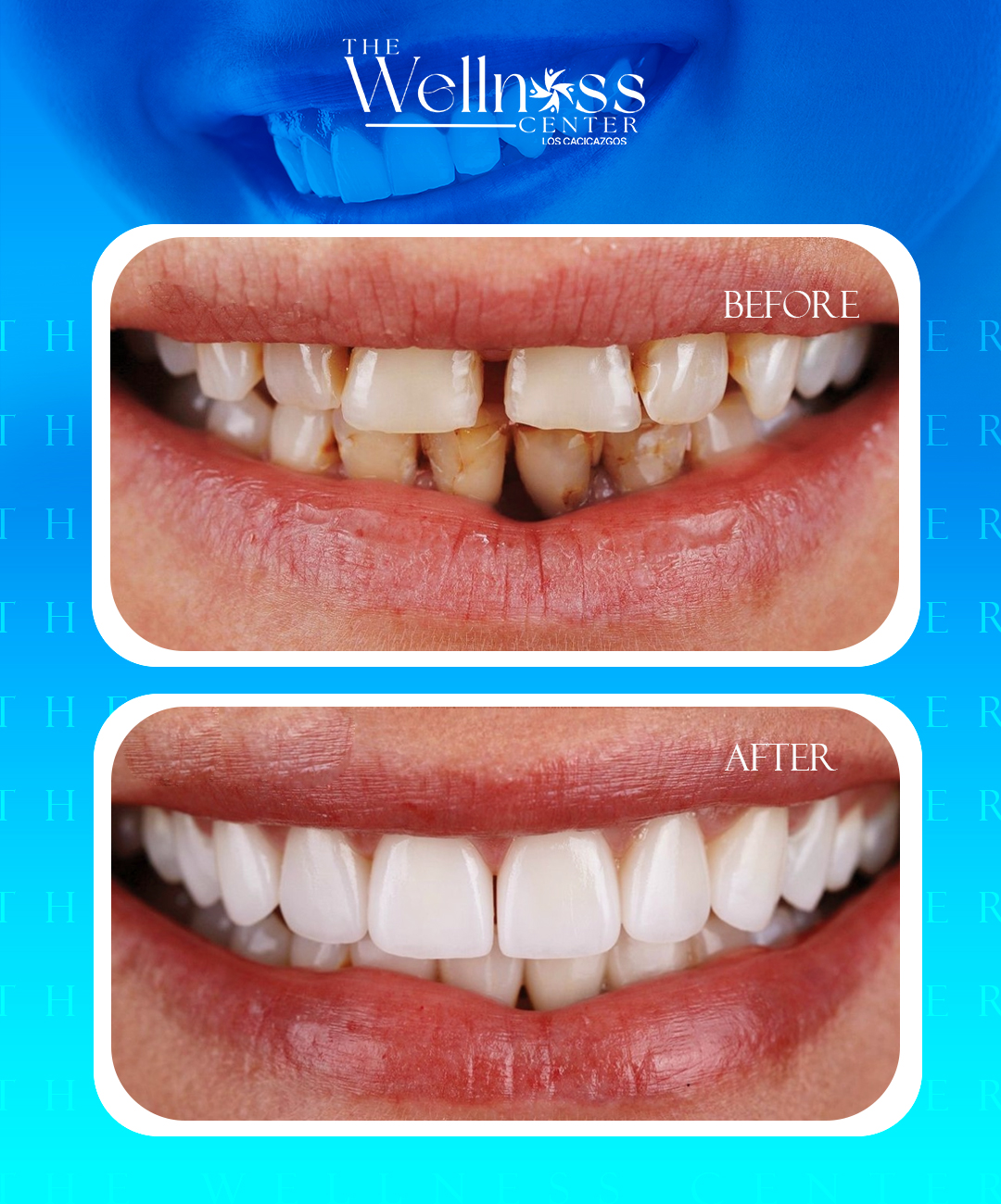 antes-y-despues-denta-3l